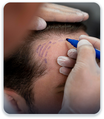 FUE Hair Transplant